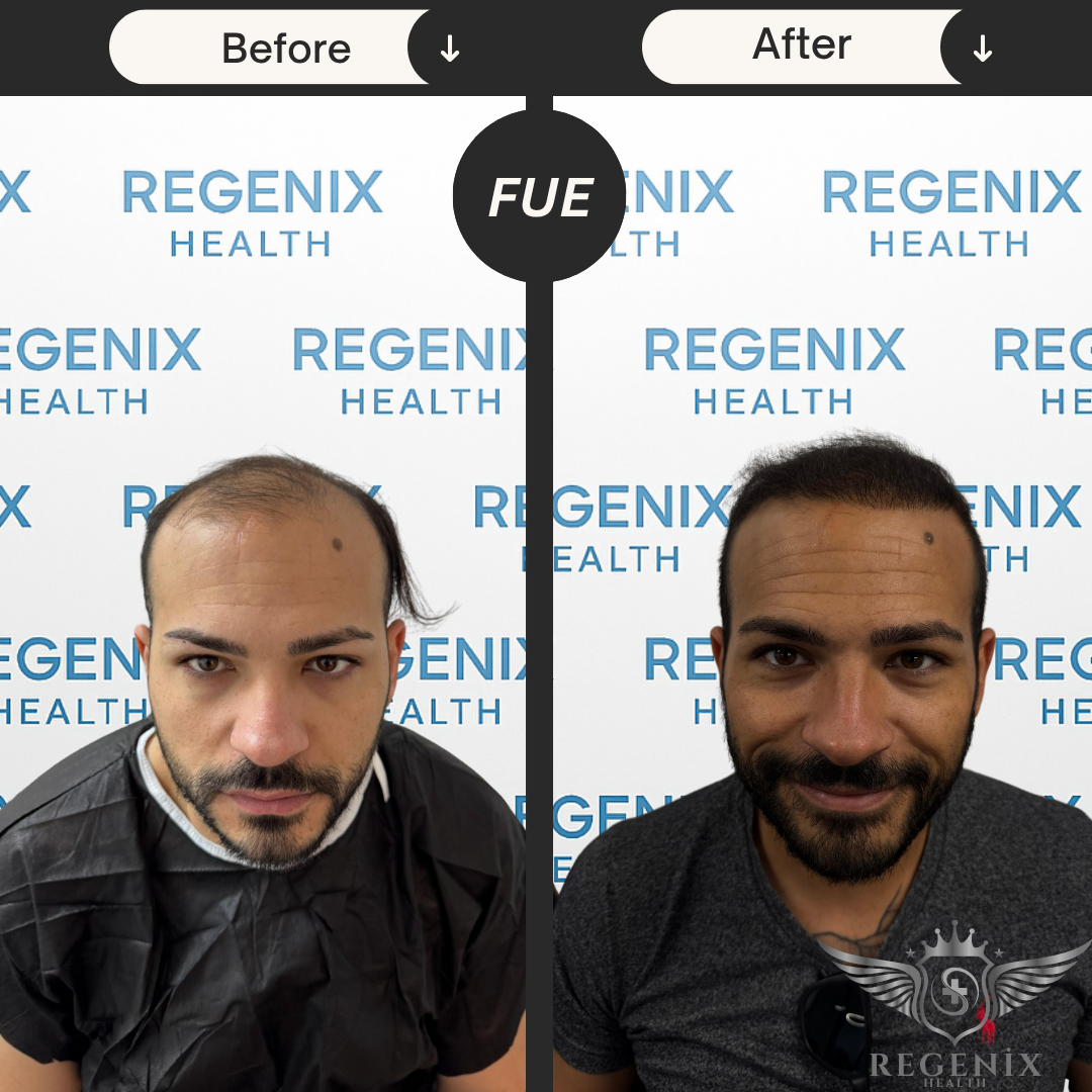 Hair Transplantation