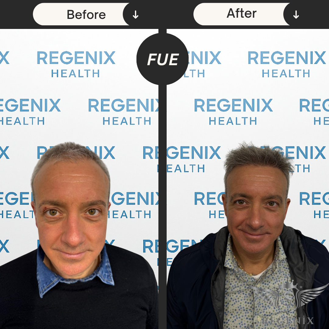 Hair Transplantation