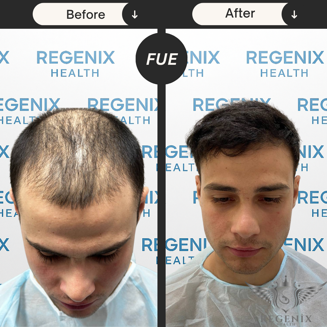 Hair Transplantation